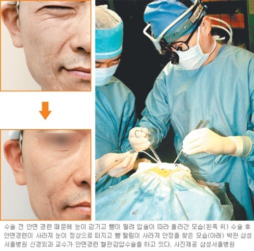 헬스&뷰티/Before&After]안면경련 혈관감압 수술｜동아일보